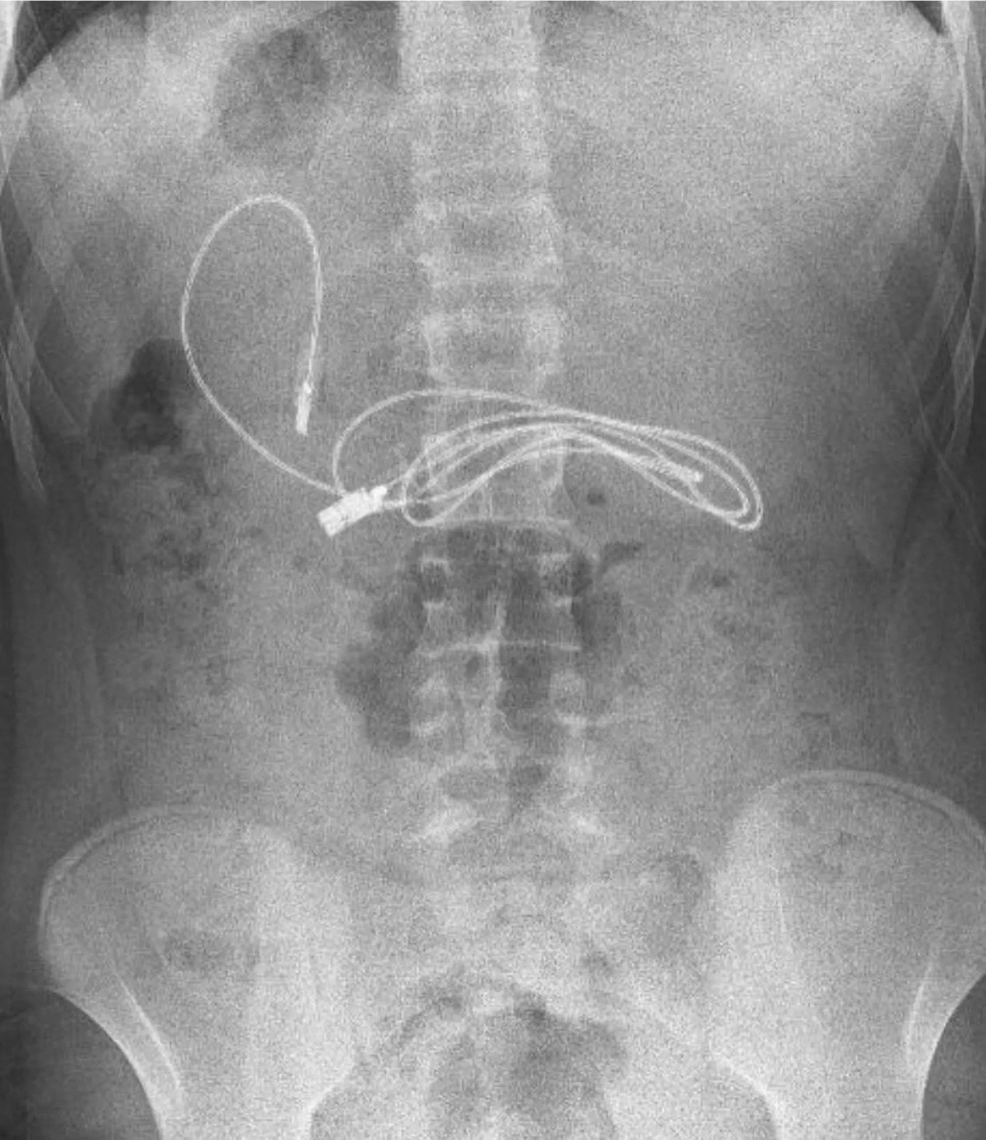 Hình ảnh chụp X-quang thấy rõ dị vật trong người cậu bé 15 tuổi Hình ảnh chụp X-quang thấy rõ dị vật trong người cậu bé 15 tuổi