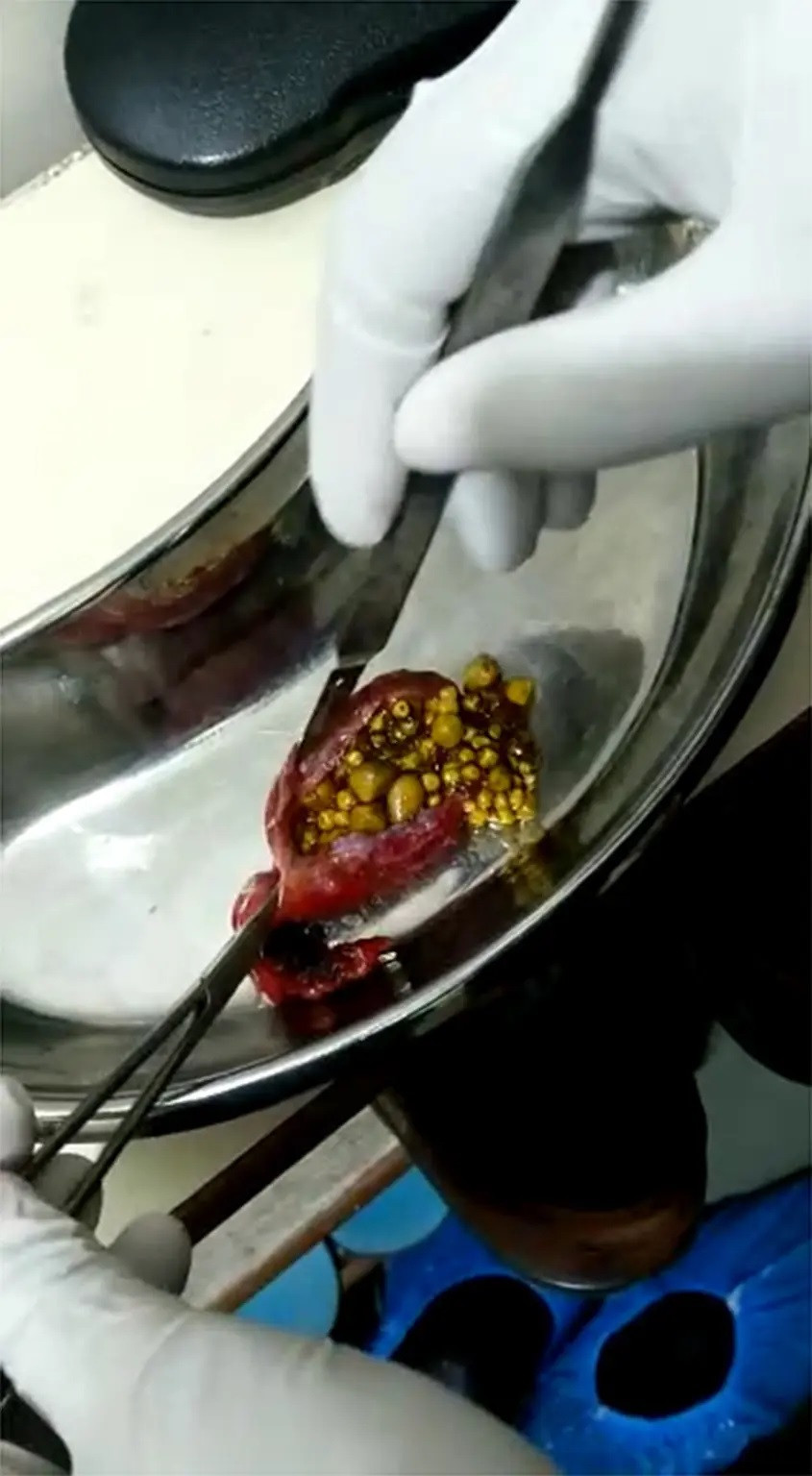 Những viên sỏi mật được lấy ra từ túi mật của Yashoda Bai.