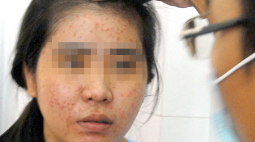 Bệnh nhân bị nổi mụn ở da mặt do sử dụng kem trộn tẩy trắng da siêu tốc. Ảnh: Q.Vinh