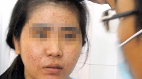 Bệnh nhân bị nổi mụn ở da mặt do sử dụng kem trộn tẩy trắng da siêu tốc. Ảnh: Q.Vinh