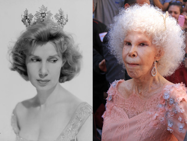 Công nương xứ Alba sau hàng trăm lần tiêm botox