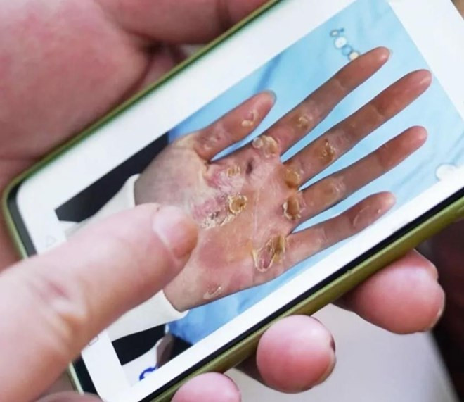 Bức ảnh bàn tay biến dạng của vận động viên