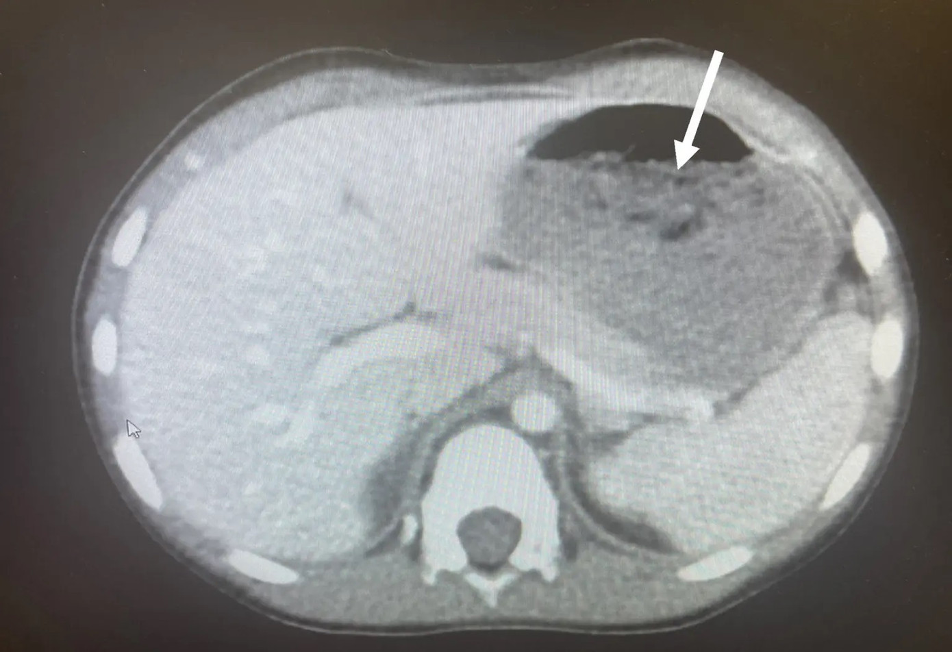 Khối kẹo cao su được nhìn thấy trên camera trong bụng cậu bé