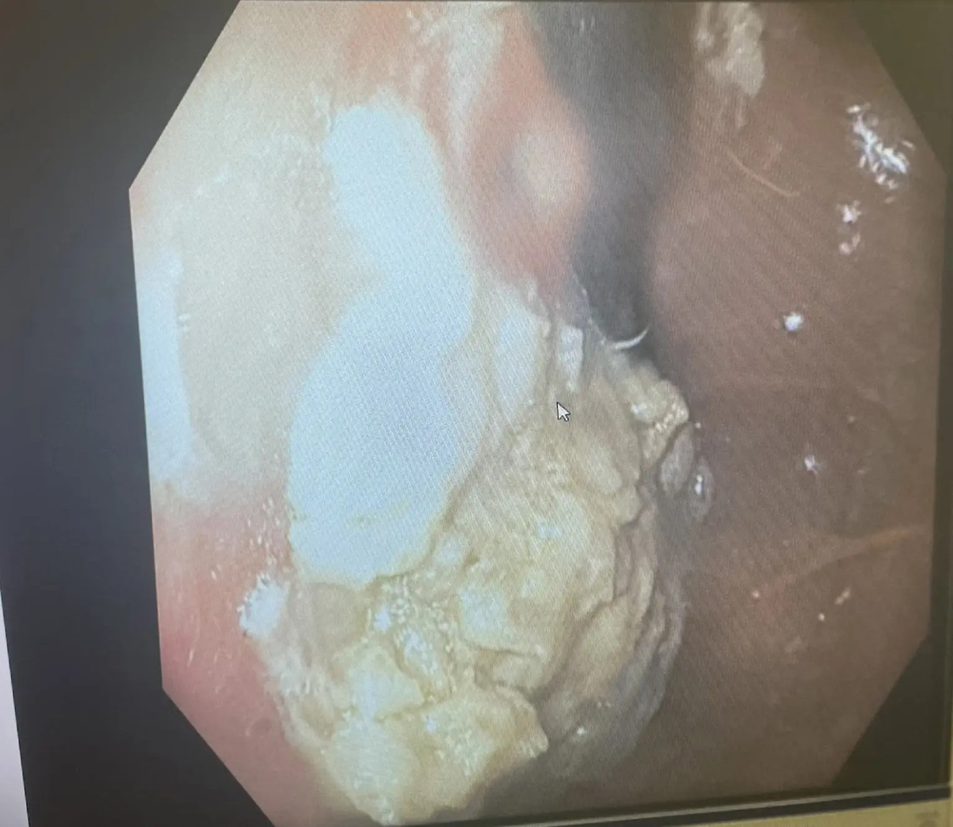 Cục kẹo cao su mắc kẹt trong bụng