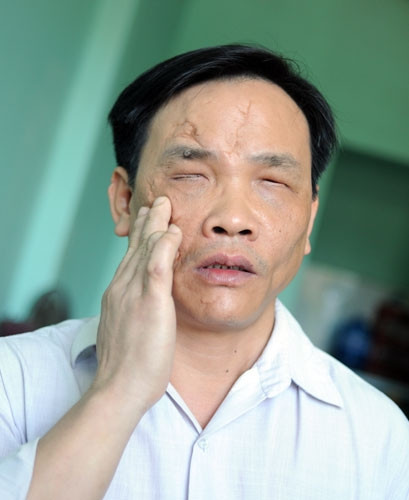 Anh Nguyễn Hưng (1973) ở Tổ 1 phường Hòa Thọ Tây, quận Cẩm Lệ, bị mù 2 mắt, chân, tay, bụng bị nhiều vết thương nặng do vướng phải mìn khi đi chăn trâu năm 1985 