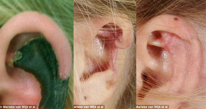 Khi mới bị nhện cắn, tai người phụ nữ Hà Lan chuyển sang màu đen (ảnh trái). Nọc độc của nhện làm hoại tử một phần da và sụn của người phụ nữ (ảnh giữa) khiến các bác sĩ buộc phải cắt bỏ phần tai hỏng và tái tạo lại phần này bằng sụn xương sườn cô (ảnh phải)