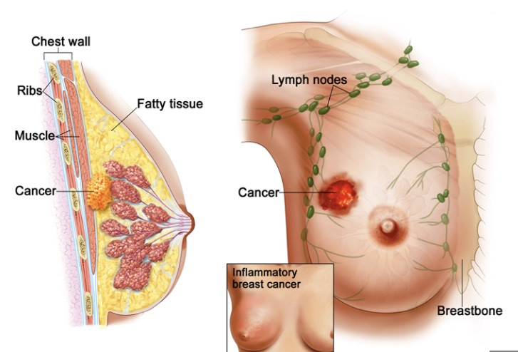 Mô phỏng sự phát triển của tế bào ung thư vú
