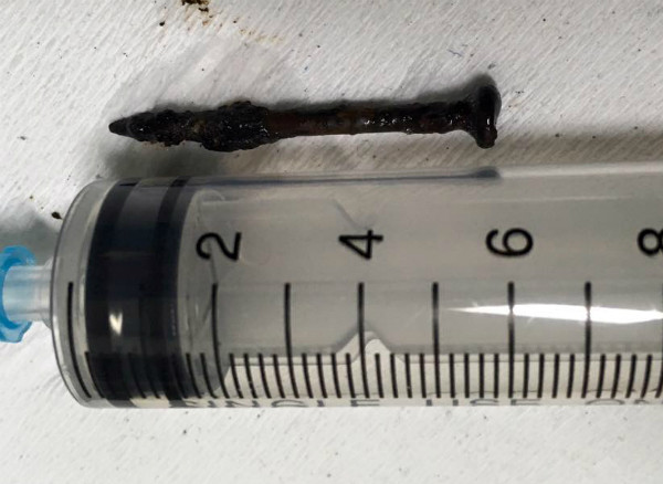 Người đàn ông bất ngờ bị đinh văng qua miệng xuống phổi ảnh 1