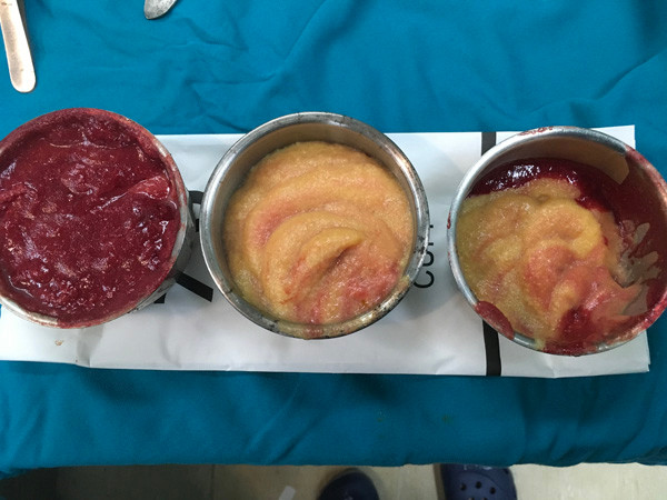 Nữ Việt kiều suýt hỏng ngực sau 3 năm tiêm silicon ảnh 1