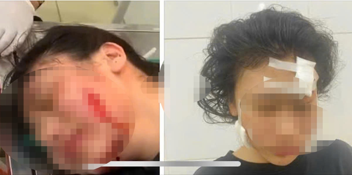 V.T.L.H. điều trị do bị rạch mặt V.T.L.H. điều trị do bị rạch mặt