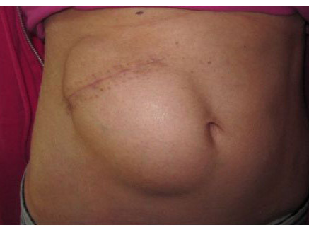 Một phần sọ của cô Hilton được các bác sỹ cấy vào bụng để bảo quản