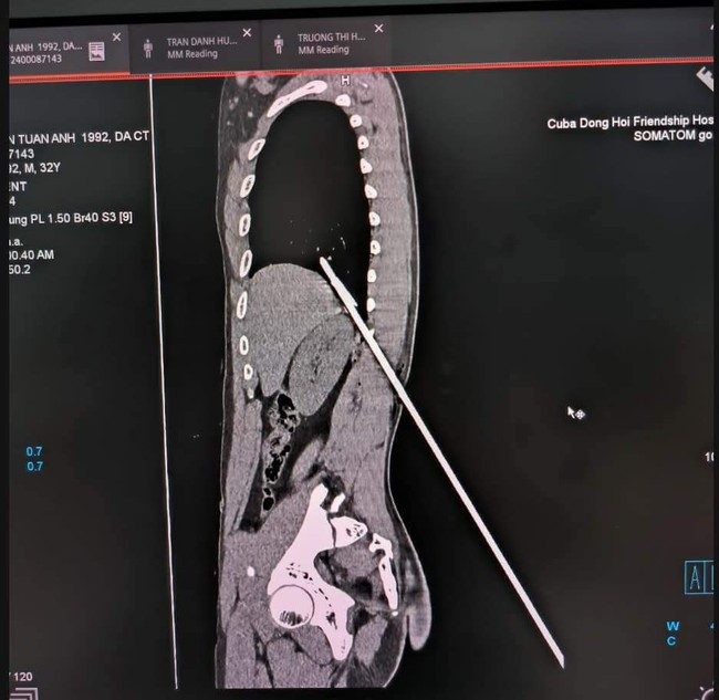 Tình trạng bệnh nhân qua ảnh chụp cắt lớp vi tính.