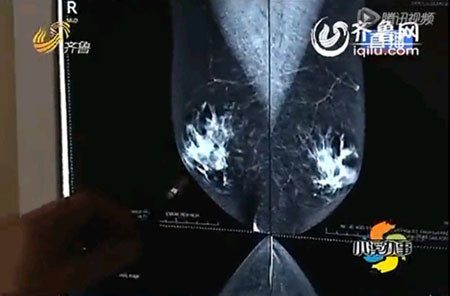 Hình ảnh X-quang bộ ngực phụ nữ của ông Tiết