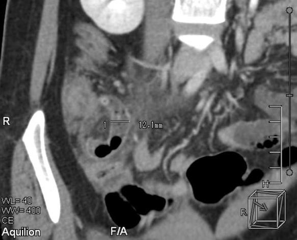 Cứu sống bệnh nhân suýt chết vì rối loạn nhịp tim hiếm gặp ảnh 1