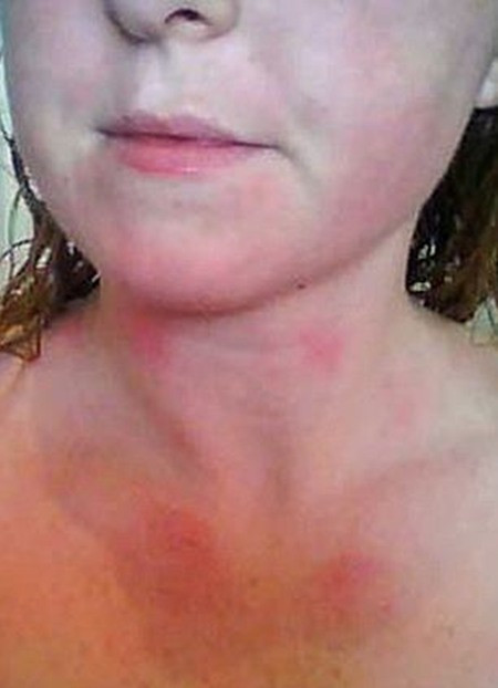 Nốt phát ban xuất hiện khi Katie tiếp xúc với nước