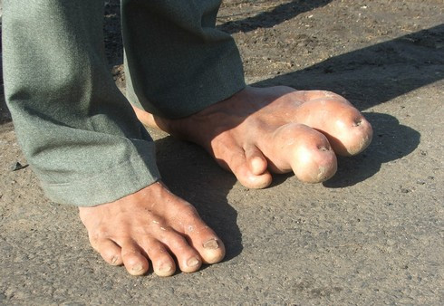 Bàn chân khổng lồ khiến anh Tài 40 năm nay không thể đi giày dép