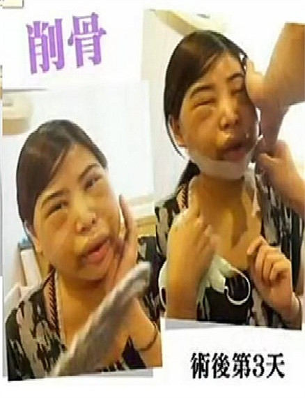 Bệnh nhân được tháo băng sau 3 ngày phẫu thuật