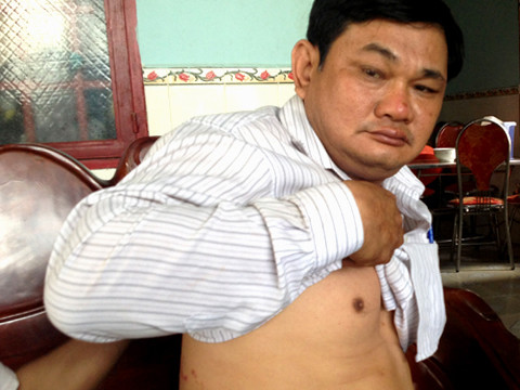 Ông Ngọc chỉ các vết tím đỏ trên người. Ông Ngọc chỉ các vết tím đỏ trên người