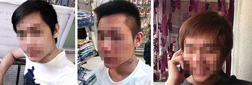 Từ trái qua phải: Anh Ngô Gia H. trước khi tiêm thuốc trắng da, bị biến chứng và sau khi điều trị. Ảnh: Internet