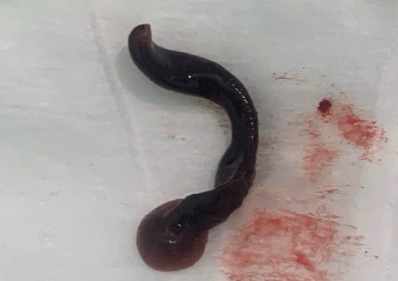 Con đỉa trong mũi bệnh nhân.