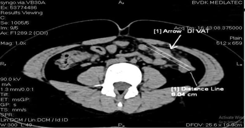 Hình ảnh dị vật dài 6cm xuyên quai ruột non và đại tràng của bé M khi chụp CT