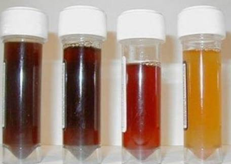 Các mức độ của máu trong nước tiểu.