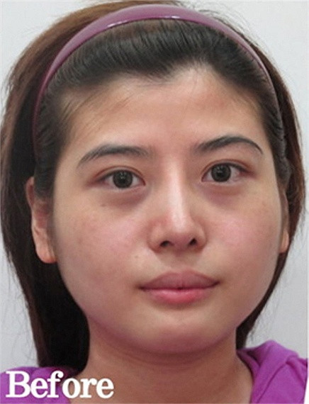 Trước khi phẫu thuật, cô gái có tên Dora được gán biệt hiệu là 'Big pancake face', tạm dịch là khuôn mặt bánh bự