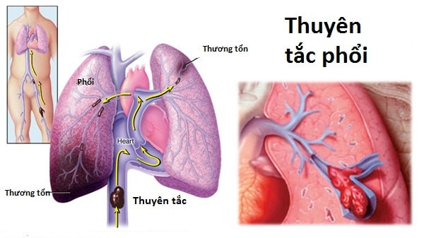 Chấn thương chân do té xe, nam thanh niên suýt chết vì thuyên tắc phổi ảnh 2