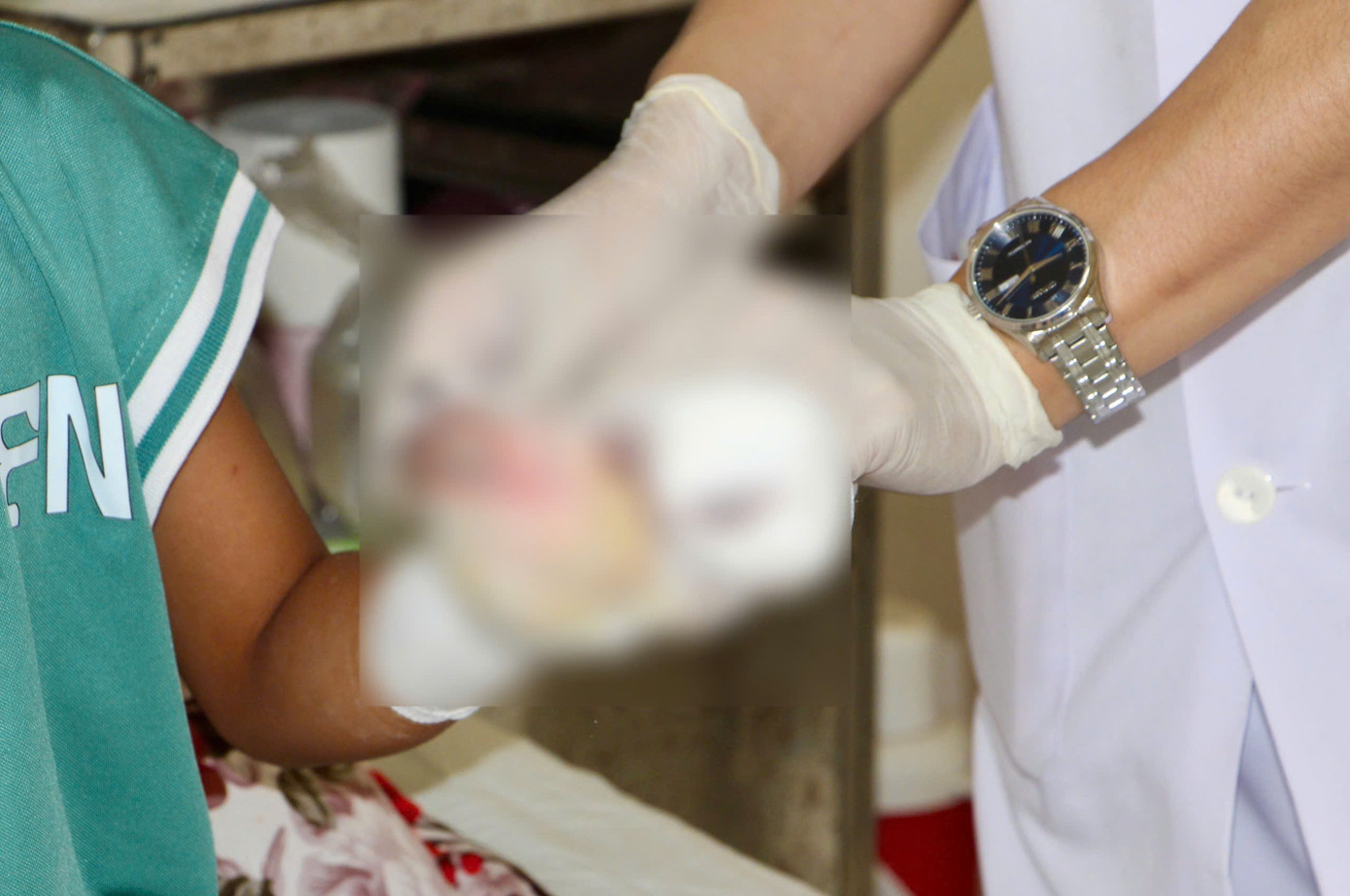 Bệnh nhi bị thương nặng ở tay do sử dụng pháo tự chế gây nổ. Bệnh nhi bị thương nặng ở tay do sử dụng pháo tự chế gây nổ.