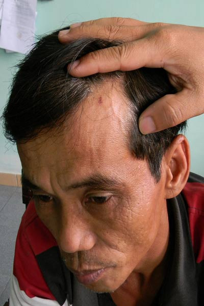 Ông Võ Văn Tâm, dân phòng phường Trường Xuân, bị Thảo tát tai gây thương tích. Ông Võ Văn Tâm, dân phòng phường Trường Xuân, bị Thảo tát tai gây thương tích