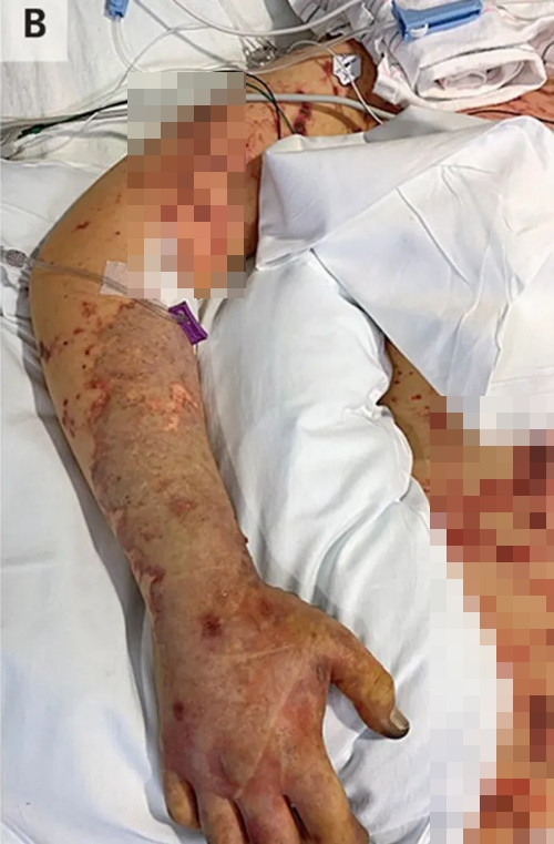 Da của JC có nhiều mảng màu chuyển màu tím. Ảnh: Tạp chí Y khoa New England. Da của JC có nhiều mảng màu chuyển màu tím. Ảnh: Tạp chí Y khoa New England.