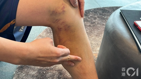 Mike bị nhiều vết thương do vụ tai nạn khi du lịch ở Thái Lan. Ảnh: HK01. Mike bị nhiều vết thương do vụ tai nạn khi du lịch ở Thái Lan. Ảnh: HK01.