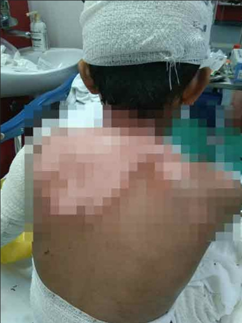 Bé trai 9 tuổi bị bỏng ở đầu và người. Ảnh: China Press. Bé trai 9 tuổi bị bỏng ở đầu và người. Ảnh: China Press.