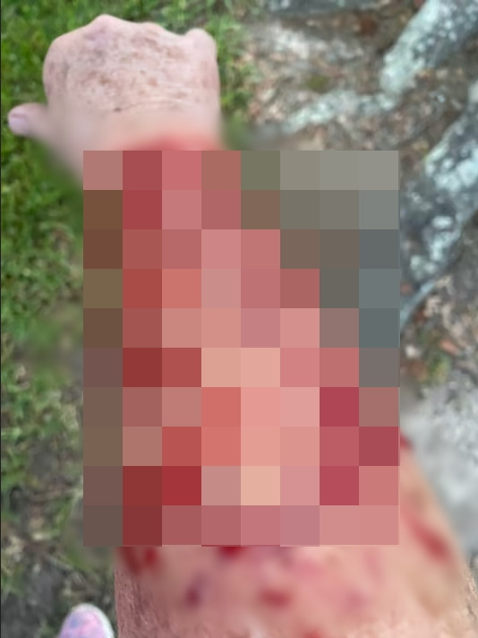 Cánh tay của cô Peggy sau khi bị 2 động vật hung dữ tấn công (hình ảnh cố ý được làm mờ). Ảnh: Click2Houston.