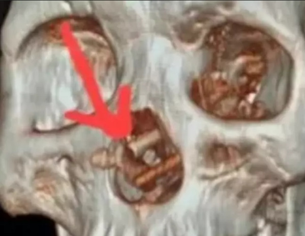 Hình ảnh đôi đũa xuyên từ mũi lên não bệnh nhân. Ảnh: Bệnh viện Hữu nghị Việt Nam - Cuba (Đồng Hới). Hình ảnh đôi đũa xuyên từ mũi lên não bệnh nhân. Ảnh: Bệnh viện Hữu nghị Việt Nam - Cuba (Đồng Hới).