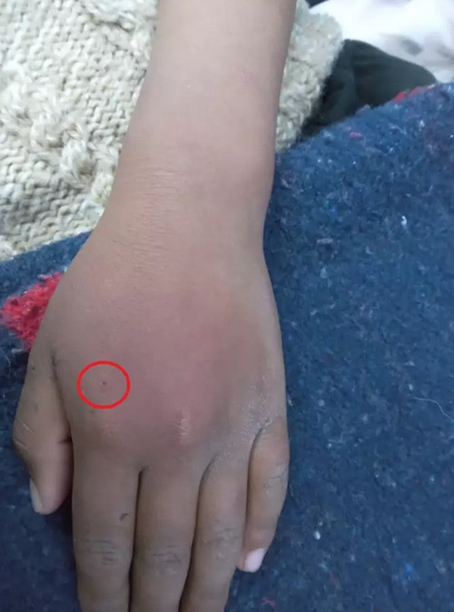 Bé trai để nhện Góa Phụ Đen cắn lên lưng bàn tay mình. Ảnh: Jam Press. Bé trai để nhện Góa Phụ Đen cắn lên lưng bàn tay mình. Ảnh: Jam Press.