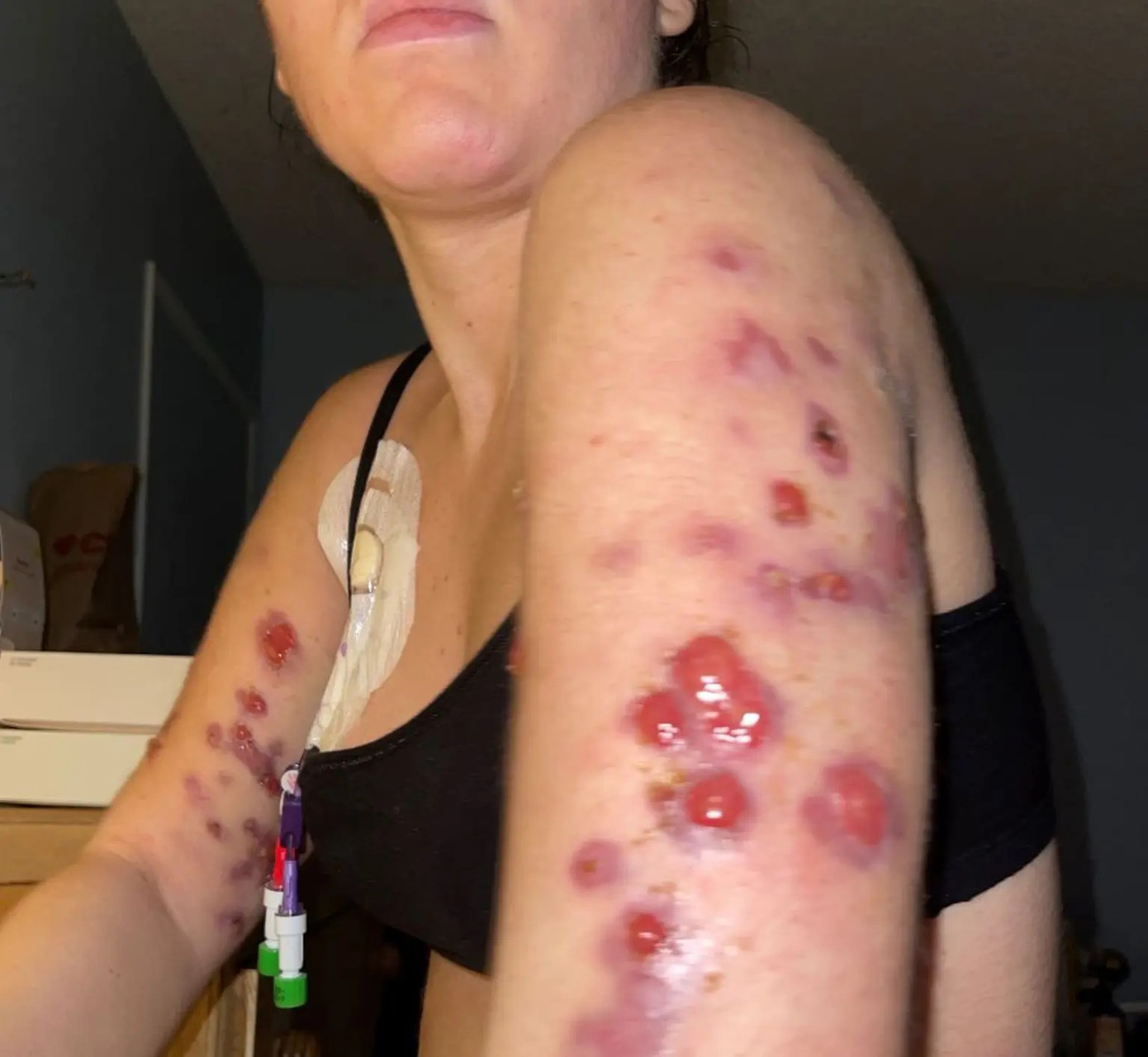 Cơ thể của Amma bị lở loét sau khi tiêm thuốc giảm béo Cơ thể của Amma bị lở loét sau khi tiêm thuốc giảm béo