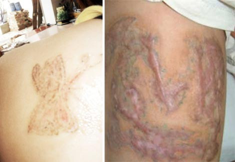 Hãi hùng công nghệ xóa hình xăm, xua vận rủi của dân chơi ảnh 1