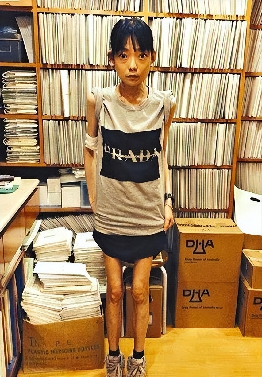 Hình ảnh gầy gò của Ngũ Trí Hằng từng khiến nhiều người sợ hãi. Hình ảnh gầy gò của Ngũ Trí Hằng từng khiến nhiều người sợ hãi.