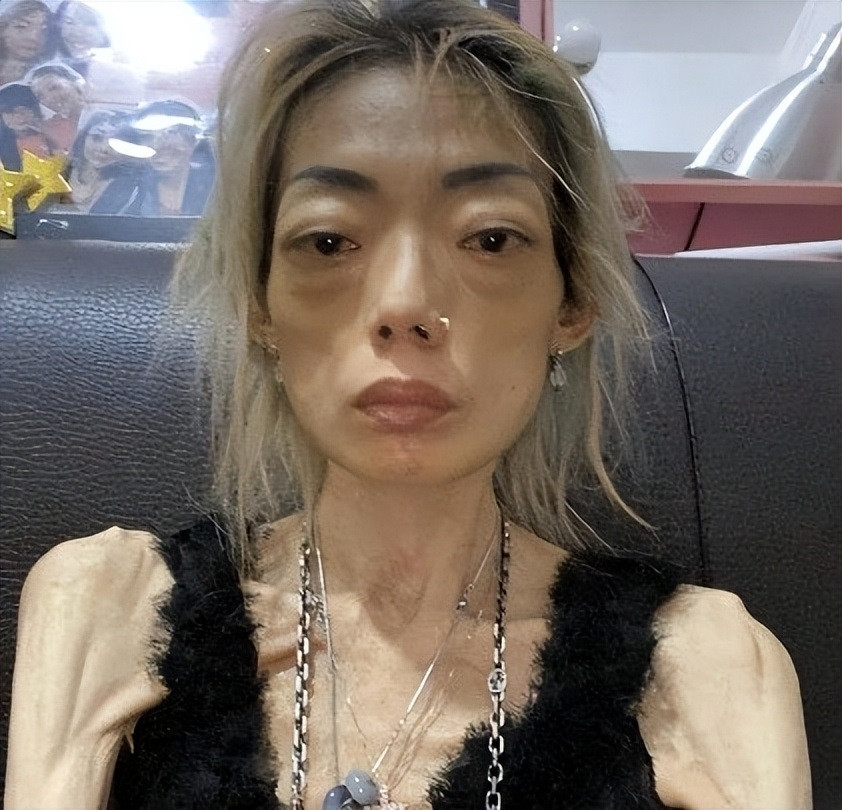 Hình ảnh gầy gò của Ngũ Trí Hằng từng khiến nhiều người sợ hãi. Hình ảnh gầy gò của Ngũ Trí Hằng từng khiến nhiều người sợ hãi.