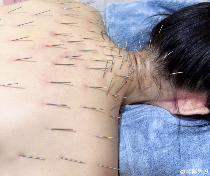 Nữ diễn viên cho biết quá trình điều trị rất đau đớn.