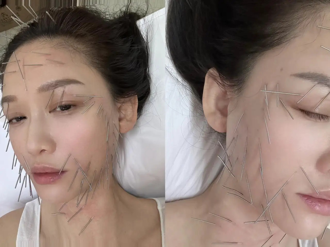 Gương mặt đầy châm của Trần Kiều Ân.