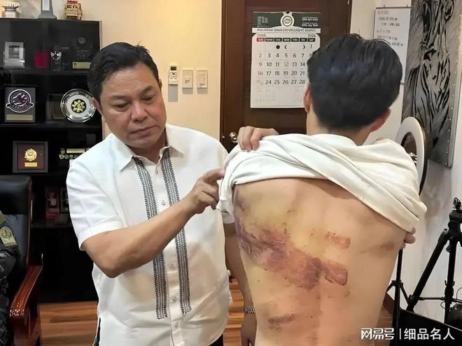 Những vụ án bắt cóc người Trung Quốc sang các trại tập trung, ép lừa đảo viễn thông đang gây phẫn nộ tại Trung Quốc. Trong ảnh là một nạn nhân chịu nhiều thương tích do bị hành hạ. Những vụ án bắt cóc người Trung Quốc sang các trại tập trung, ép lừa đảo viễn thông đang gây phẫn nộ tại Trung Quốc. Trong ảnh là một nạn nhân chịu nhiều thương tích do bị hành hạ.