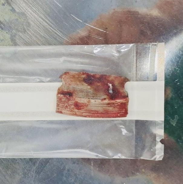 Dị vật được lấy từ trong vùng bụng nạn nhân