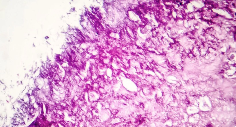 Phương pháp dùng ánh sáng cận hồng ngoại để làm rung phân tử có thể tiêu diệt 99% tế bào ung thư. (Ảnh: Euro News) Phương pháp dùng ánh sáng cận hồng ngoại để làm rung phân tử có thể tiêu diệt 99% tế bào ung thư. (Ảnh: Euro News)