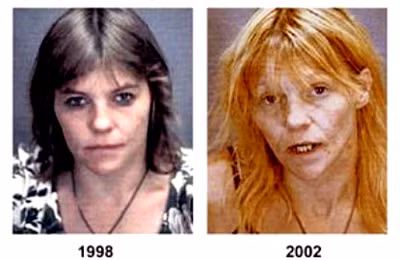 Một phụ nữ sau 4 năm sử dụng ma túy “đá”. Ảnh Blog tacke.