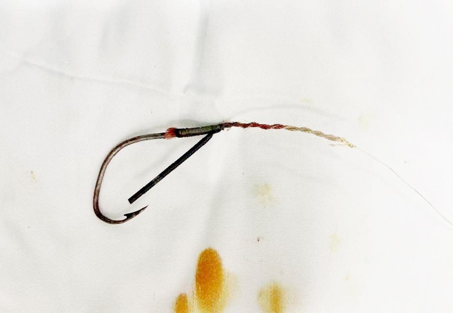 Lưỡi câu móc vào mắt bệnh nhân được bác sĩ mổ lấy ra.