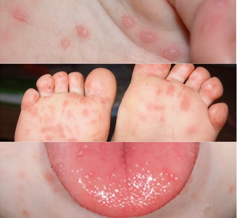 Chủng virus gây đại dịch tay chân miệng năm 2011 đã trở lại? ảnh 1