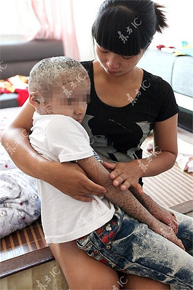 Căn bệnh không chỉ ảnh hưởng đến hình dạng mí mắt, mũi, miệng và tai của bé Pan, nó còn hạn chế khả năng vận động tứ chi của bé