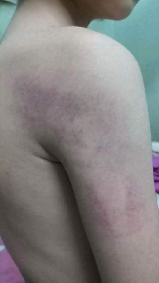 Cô giáo bị tố đánh học sinh lớp 1 tím người ảnh 1